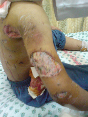 Phosphorus burns Phosphorus burns